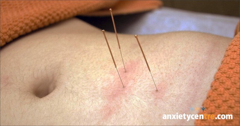 acupuncture and anxiety