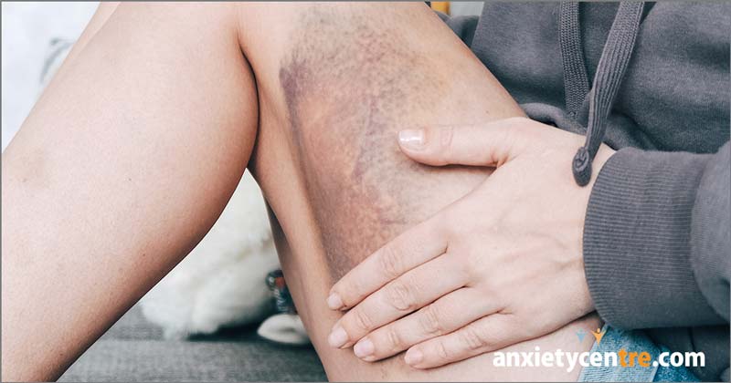 easy bruising and anxiety